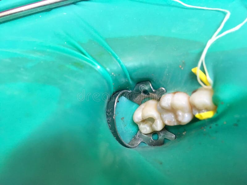 El tratamiento pulpotomy o de la endodoncia parcial en la muela t del ` s del niño fotografía de archivo libre de regalías El tratamiento pulpotomy o de la endodoncia parcial en la muela t del ` s del niño fotografía de archivo libre de regalías