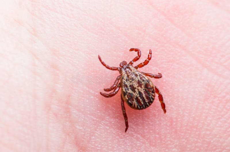 Encephalitis Virus or Lyme Disease Infected Tick Arachnid Insect on Skin Macro. Encephalitis Virus or Lyme Disease Infected Tick Arachnid Insect on Skin Macro