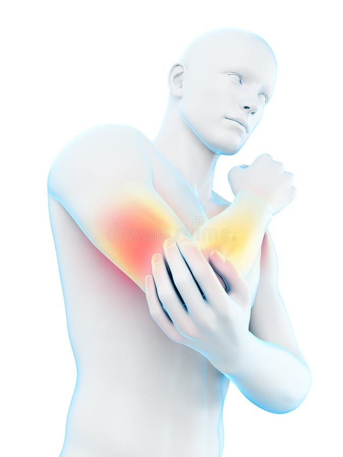 Elbow Pain Location. Bursitis of Arm Joint Dislocated Sprain Arthritis Arthrosis Epicondylitis