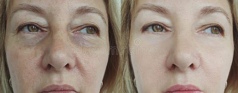 Elderly woman face wrinkles correction removal revitalization difference tension before after t