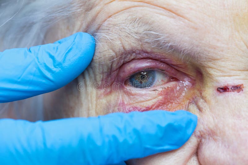 Elderly woman`s injured eye & nurse`s fingers stock photo Elderly woman`s injured eye & nurse`s fingers stock photo