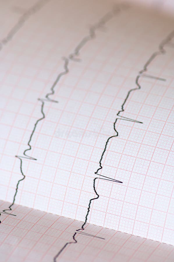 Electrocardiogram