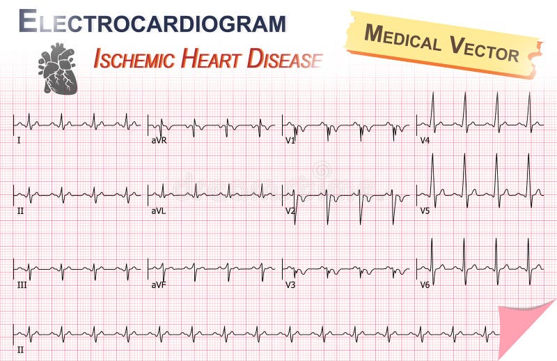 Electrocardiogram ( ECG , EKG ) of Ischemic Heart Disease ( Myocardial Infarction ) and Anatomy of heart icon royalty free illustration Electrocardiogram ( ECG , EKG ) of Ischemic Heart Disease ( Myocardial Infarction ) and Anatomy of heart icon royalty free illustration