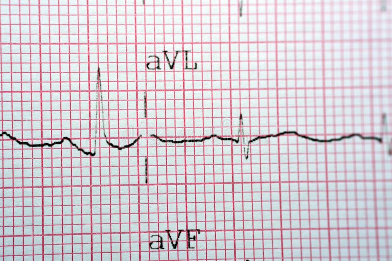 Electrocardiogram ECG in a graph paper shows normal Sinus rhythm, Vital signs and medical healthcare symbol, selective focus of ElectroCardioGraph made for a cardiac patient to exclude angina pectoris