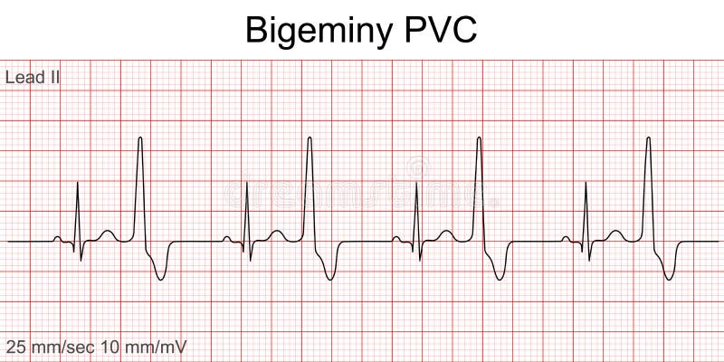 Ventricular Fibrillation Heart Stock Illustrations 69 Ventricular Fibrillation Heart Stock Illustrations Vectors Clipart Dreamstime Ventricular Fibrillation Heart Stock Illustrations 69 Ventricular Fibrillation Heart Stock Illustrations Vectors Clipart Dreamstime