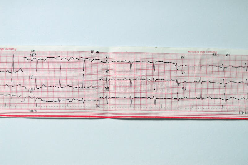 An ElectroCardioGraph ECG, a chart that draws the electricity of the heart and gives an idea on the heart condition and the rhythm and excludes any angina pectoris or myocardial infarction, Normal ECG