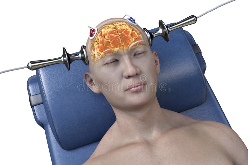 Electroconvulsive Therapy, ECT, a Treatment Involving the Use of