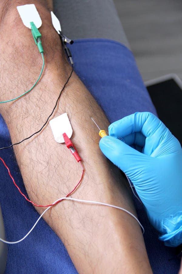 Electromyography Graphic Recording of the Electrical Activity Produced by the Tibial Muscle