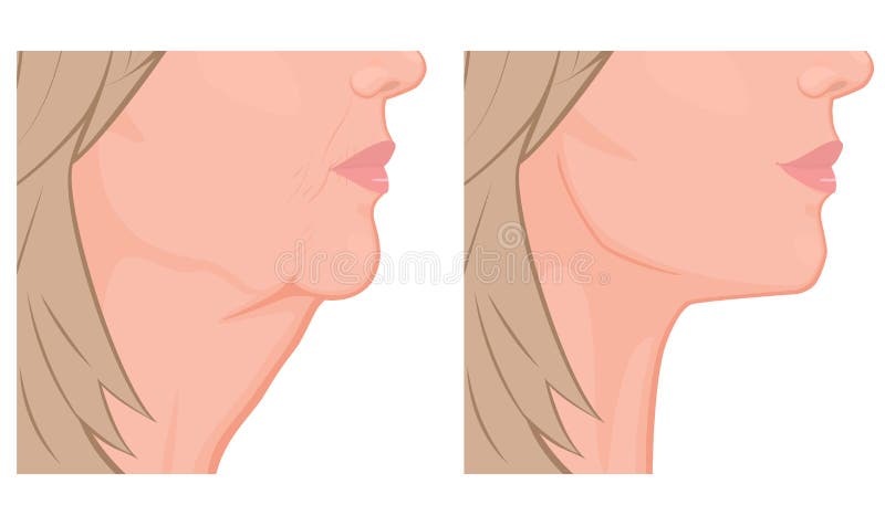 Elevación de cara mayor del view_Neck antes y después ilustración del vector Elevación de cara mayor del view_Neck antes y después ilustración del vector
