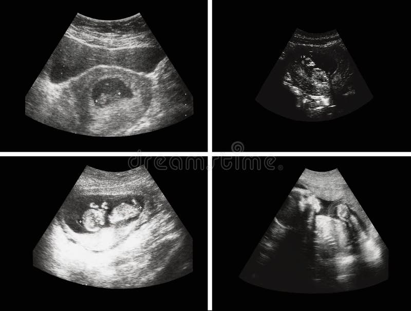 The ultrasound examination is demonstrating different stages of the human fetus developing with the detailed anatomy. The screen shoots are isolated on black. The ultrasound examination is demonstrating different stages of the human fetus developing with the detailed anatomy. The screen shoots are isolated on black.