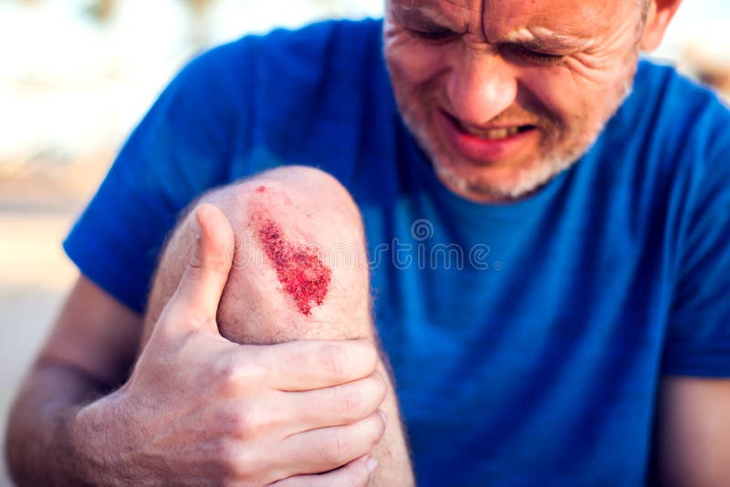 Emergency Accident Open Abrasion Wound Trauma Skin Leg Knee Stock Photo