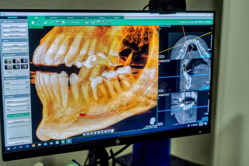 A computer monitor displaying a 3D rendered image of a human mouth with a tooth model placed in front of it. A computer monitor displaying a 3D rendered image of a human mouth with a tooth model placed in front of it