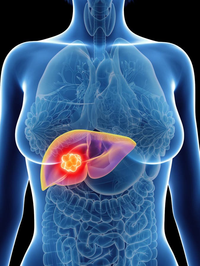 En kvinnas levercancer stock illustrationer En kvinnas levercancer stock illustrationer