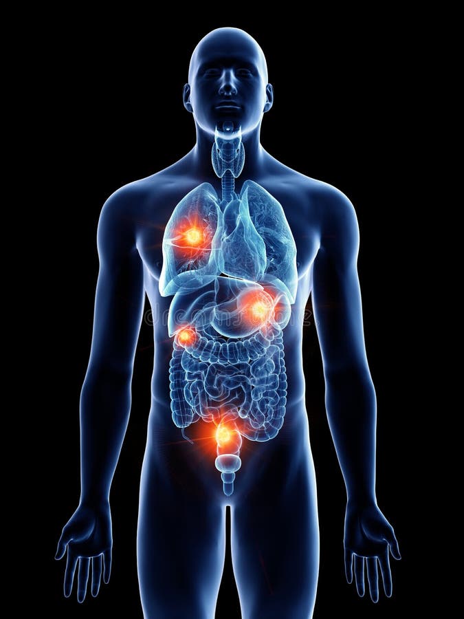 En man med metastases stock illustrationer En man med metastases stock illustrationer