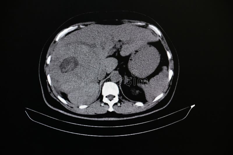 Image of a computer tomography, or CT san, of a patient& x27;s abdomen showing a large liver mass. Image of a computer tomography, or CT san, of a patient& x27;s abdomen showing a large liver mass.