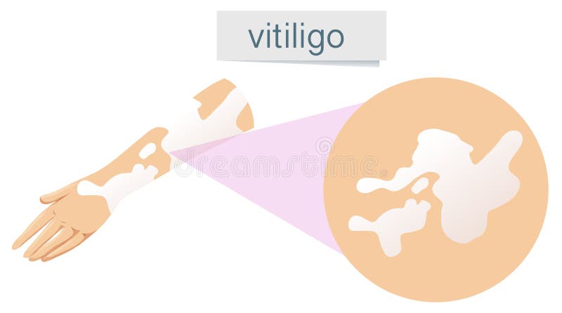 En vektor av vitiligoen på hud stock illustrationer En vektor av vitiligoen på hud stock illustrationer