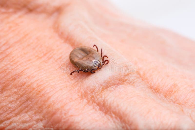 Encephalitis Virus or Lyme Disease or Monkey Fever Infected Tick Arachnid Insect on Skin Macro