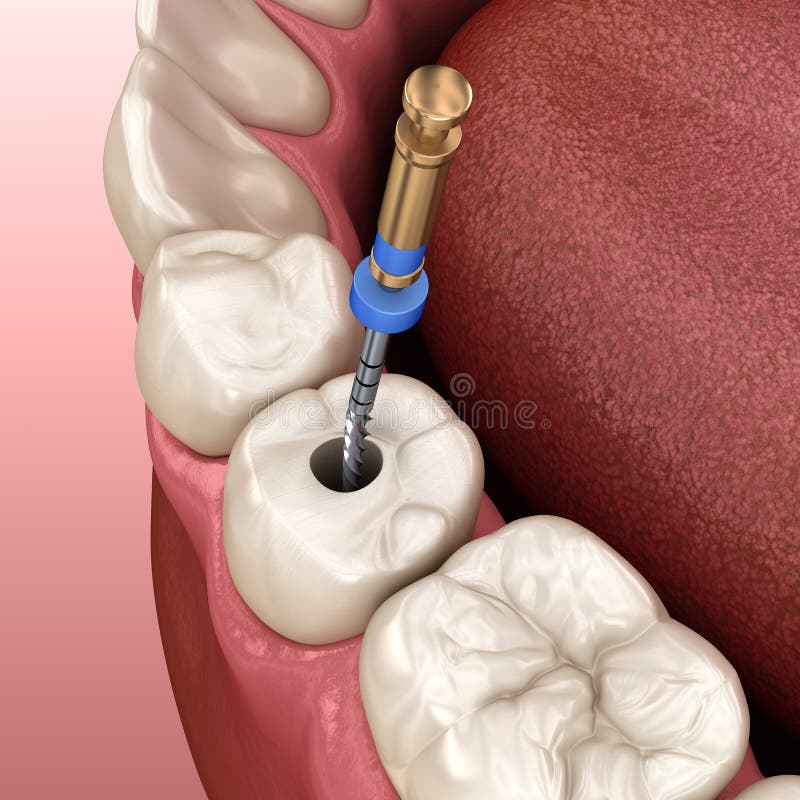 Endodontic Root Canal Treatment Process. Medically Accurate Tooth