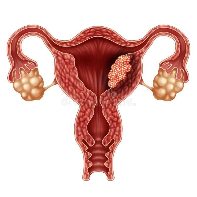 giardia kat önmagát viselkedik uvula pikkelyes papilloma icd 10