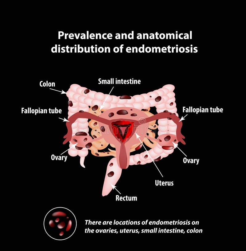 Endometriosis El Aspecto De La Endometriosis De La Enfermedad Endometrio Colon Pequeño Intestino 5357