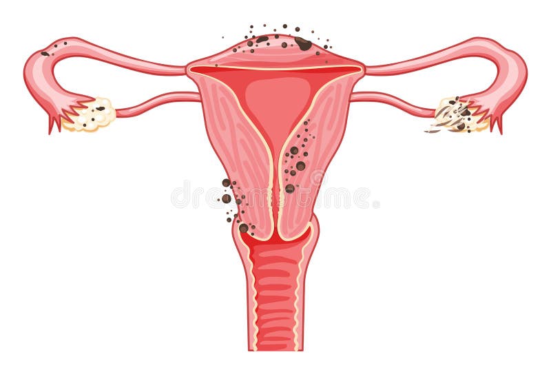 The Concept of Women`s Health with a Female Body, a Female Groin, a Uterus  and Flowers in the Pelvic Area. Vector Illustration Stock Vector -  Illustration of medical, internal: 228006040