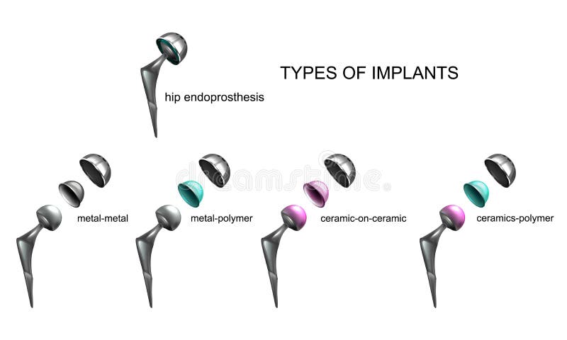 Vector illustration of types of implants by type of material. Vector illustration of types of implants by type of material