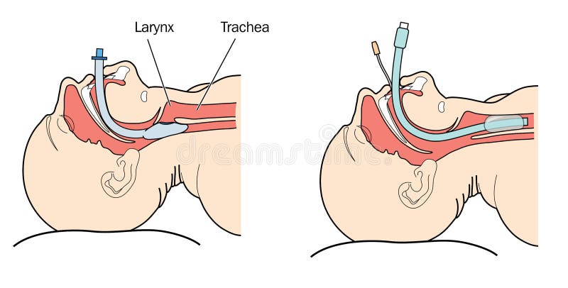 Endotracheal tube stock illustration Endotracheal tube stock illustration