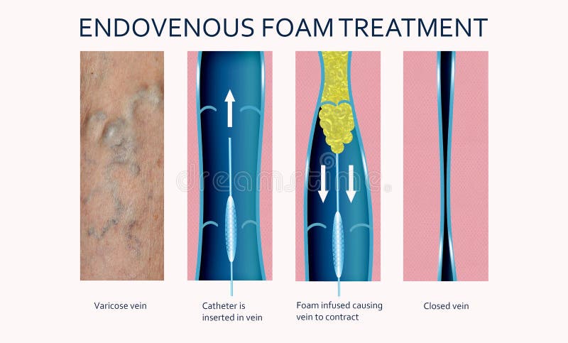 Endovenous laser treatment for varicose veins - foam sclerotherapy concept.