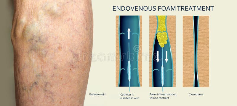 Endovenous laser treatment for varicose veins - foam sclerotherapy concept.