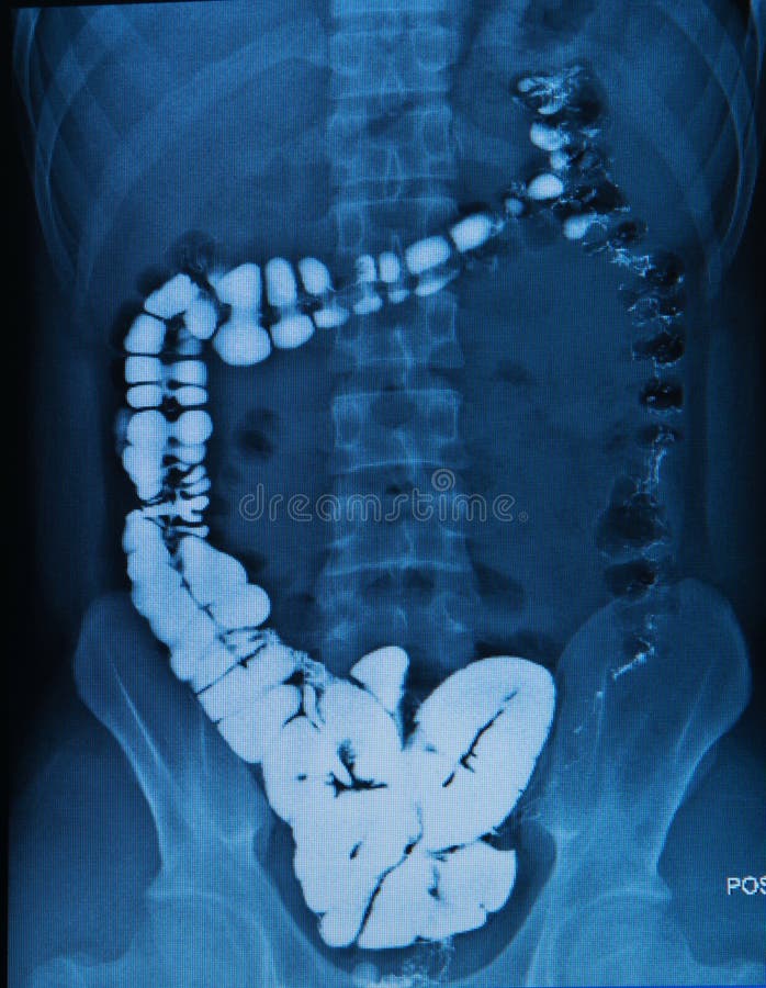 Barium enema of a man demonstrated the normal cecum. Barium enema of a man demonstrated the normal cecum