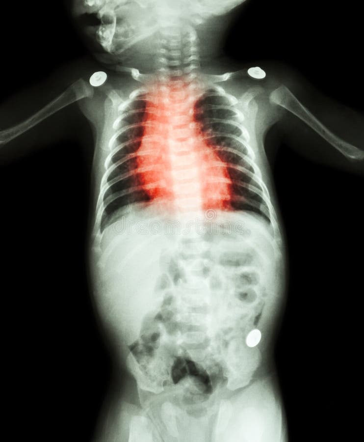 Congenital Heart Disease , Rheumatic Heart Disease ( X-ray whole body of child and red color on heart area ). Congenital Heart Disease , Rheumatic Heart Disease ( X-ray whole body of child and red color on heart area )