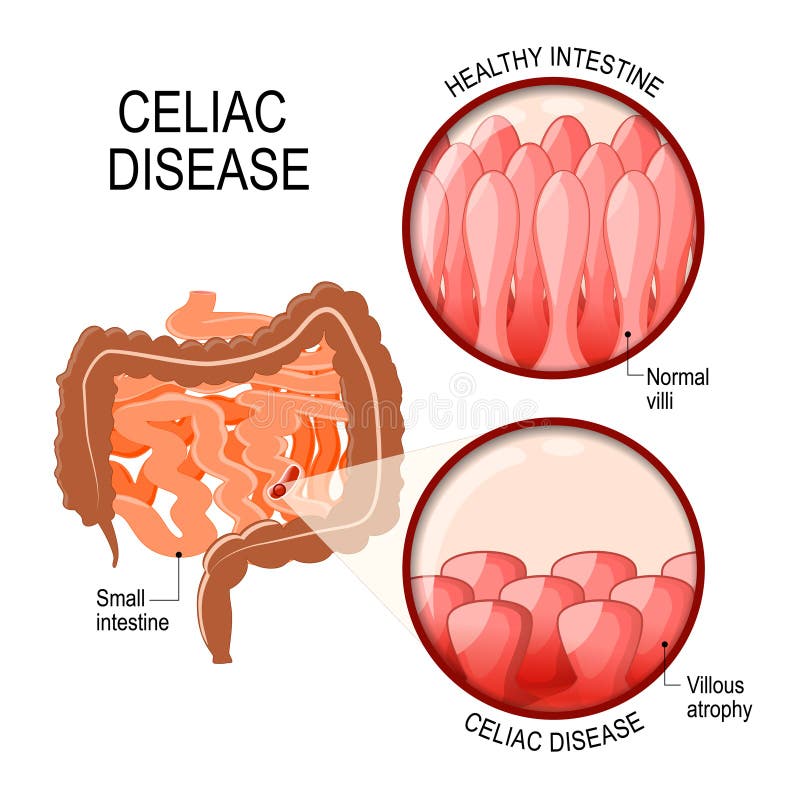 Enfermedad celiaca pequeños intestinal con las vellosidades normales, y velloso