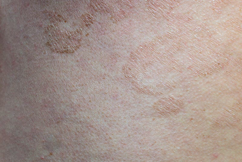 Enfermedad Cutánea De Cierre Tinea Versicolorpityriasis Versicolor