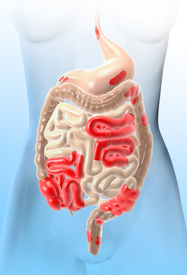Enfermedad de Crohn, un tipo de enfermedad inflamatoria intestinal DNI, dolor abdominal, ilustración médicamente 3D