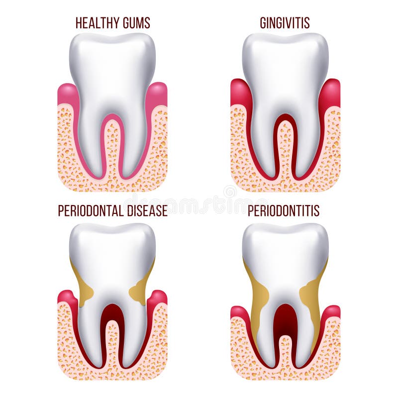 Enfermedad de las encías humana, sangría de gomas Prevención dental, infographics oral del diente del vector del cuidado