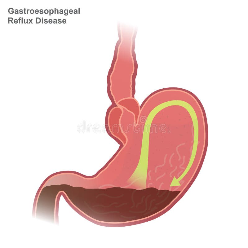 Enfermedad GERD del reflujo gastroesofágico libre illustration Enfermedad GERD del reflujo gastroesofágico libre illustration