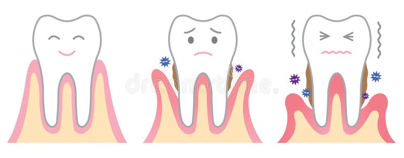 Enfermedad periodontal ilustración del vector Enfermedad periodontal ilustración del vector