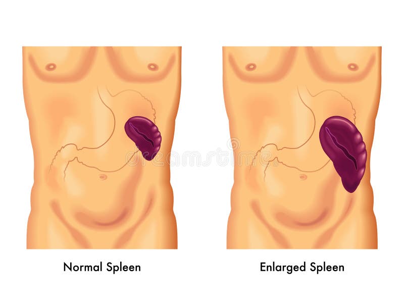 Hemolytic Anemia Stock Illustrations – 163 Hemolytic Anemia Stock Illustrations, Vectors & Clipart - Dreamstime Hemolytic Anemia Stock Illustrations – 163 Hemolytic Anemia Stock Illustrations, Vectors & Clipart - Dreamstime