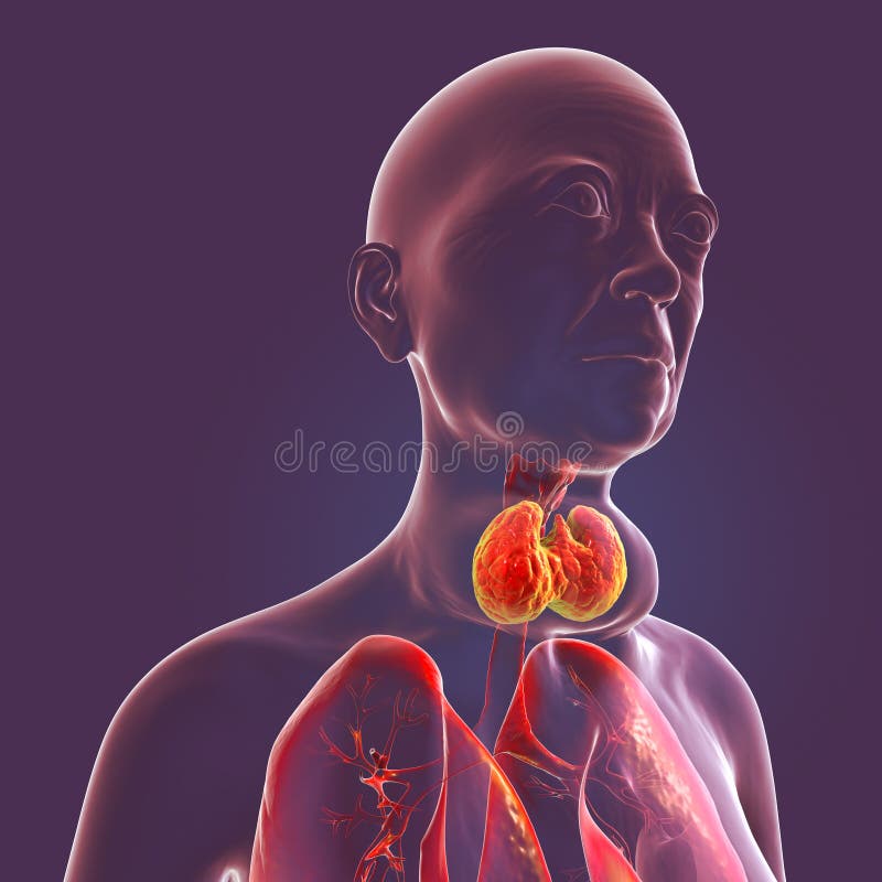 Enlarged Thyroid Gland, 3D Illustration Stock Illustration