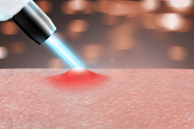 Enlèvement d'acné de laser de procédure de cosmétologie sur des parties du corps Fin vers le haut photos stock Enlèvement d'acné de laser de procédure de cosmétologie sur des parties du corps Fin vers le haut photos stock