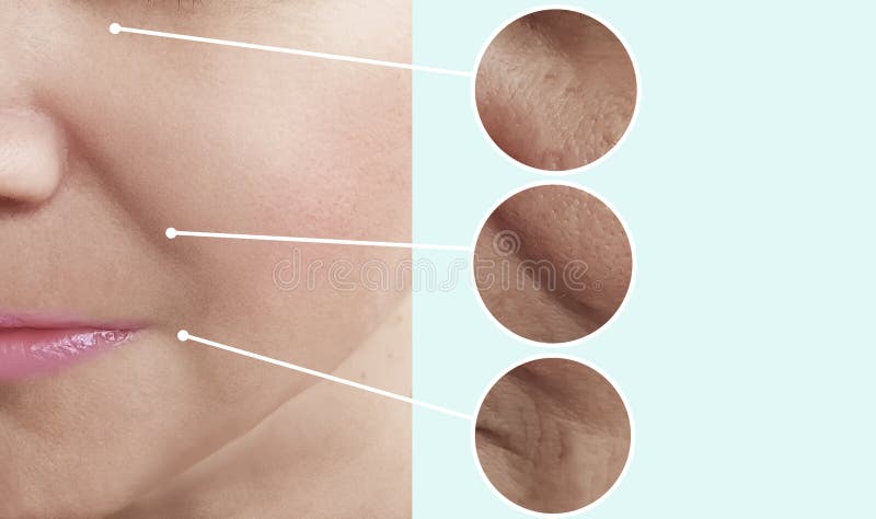 Enrugamentos fêmeas da beleza antes após tratamentos da tensão do efeito do esteticista da colagem da diferença fotos de stock Enrugamentos fêmeas da beleza antes após tratamentos da tensão do efeito do esteticista da colagem da diferença fotos de stock