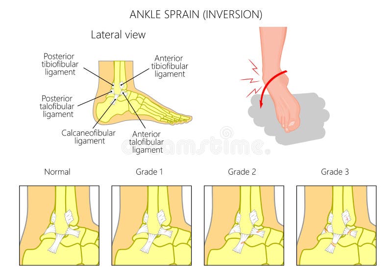 Mechanism of formation of an ankle sprain and Grades of an ankle sprain (Inversion) illustration with external and skeletal (lateral) view. Mechanism of formation of an ankle sprain and Grades of an ankle sprain (Inversion) illustration with external and skeletal (lateral) view