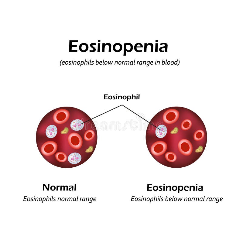 Eosinophils Below Normal Range in Blood. Eosinopenia. Infographics
