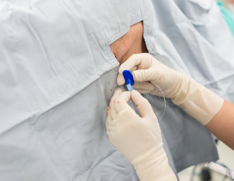 Epidural analgesia stock image. Image of human, injecting 45095525