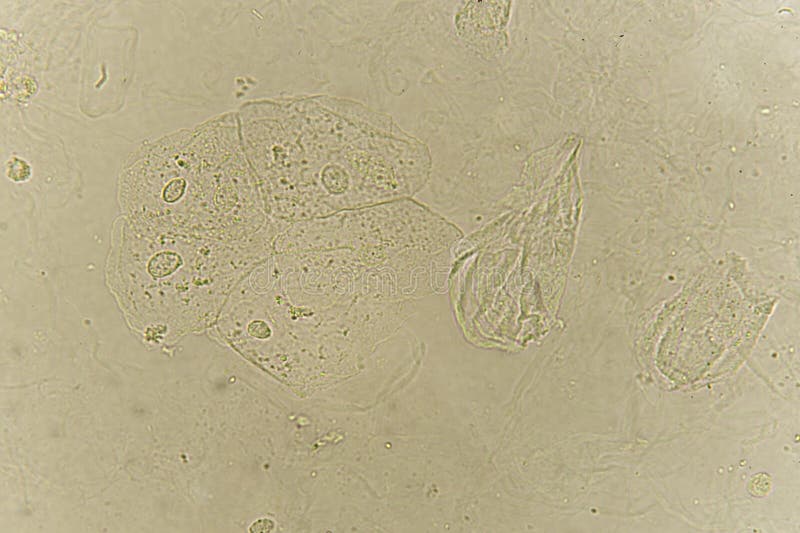 Epithelial cells in urine