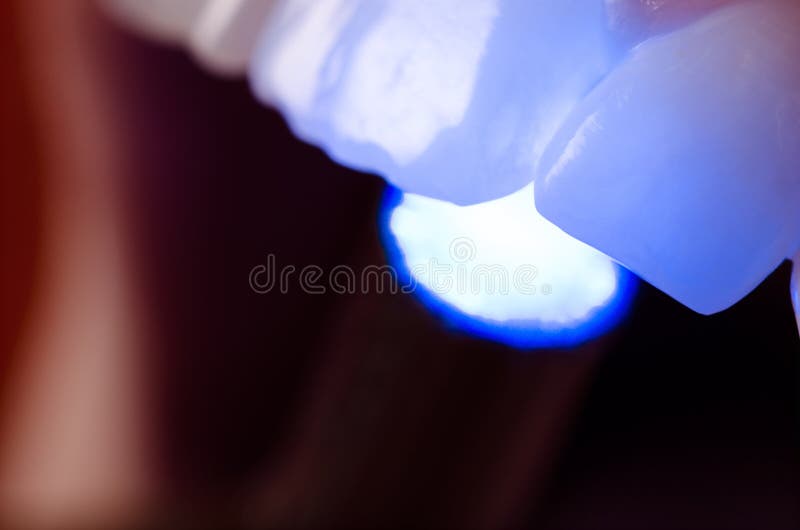 Equipo de la luz ultravioleta del dentista presionado en los dientes Cierre para arriba imagen de archivo libre de regalías Equipo de la luz ultravioleta del dentista presionado en los dientes Cierre para arriba imagen de archivo libre de regalías