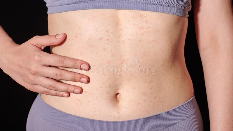 Eruzione Allergica Rossa Sulla Pelle Della Pancia Dermatite Atopica
