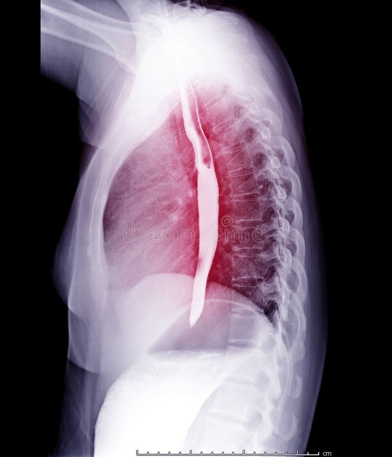Esophagram or Barium Swallow Front View Showing Esophagus for Diagnosis GERD. Stock Image - Image of gastric, abdominal: 161522023 Esophagram Or Barium Swallow Front View Showing Esophagus For Diagnosis Gerd. Stock Image - Image Of Gastric, Abdominal: 161522023