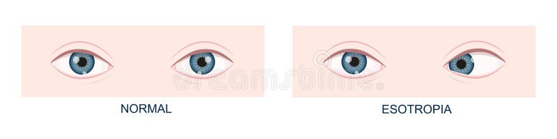 Eye Strabismus Stock Illustrations – 145 Eye Strabismus Stock  Illustrations, Vectors & Clipart - Dreamstime