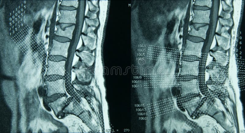 Espina dorsal lumbar de MRI imagen de archivo Espina dorsal lumbar de MRI imagen de archivo